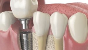 Bảng giá dịch vụ cấy ghép implant tại nha khoa Park Way