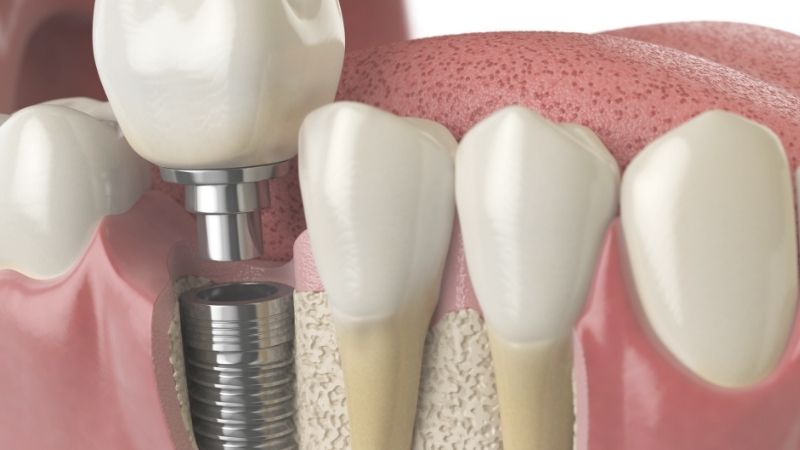 Bảng giá dịch vụ cấy ghép implant tại nha khoa Park Way 