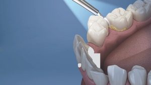 Cập nhật bảng giá cạo vôi răng Tphcm và bảng giá làm răng tại nha khoa ParkWay