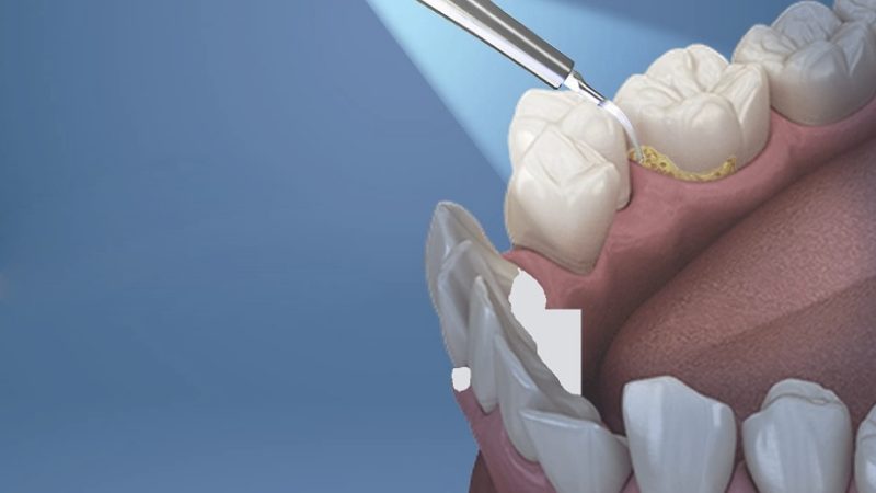 Cập nhật bảng giá cạo vôi răng Tphcm và bảng giá làm răng tại nha khoa ParkWay 