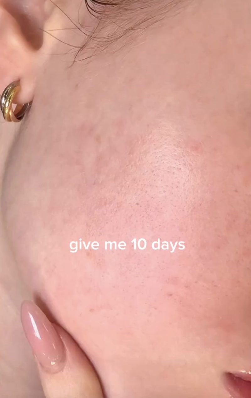 Mỹ phẩm vi kim (spicules): Trò chơi Mỹ phẩm vi kim (spicules): Trò chơi