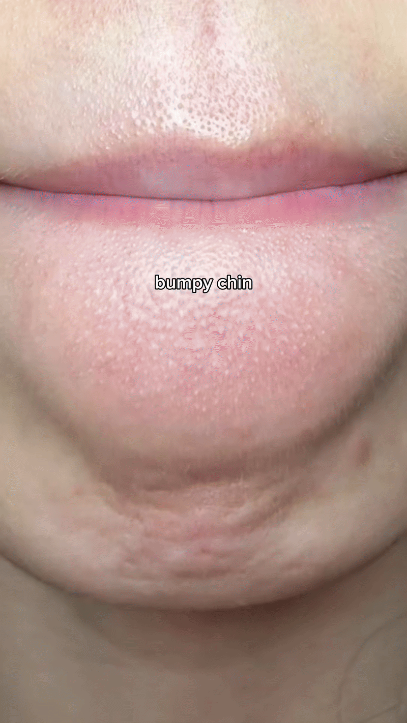 Nhiều người bôi “thạch đỏ” lên da, đến lúc nhìn lại lỗ chân lông mà giật mình- Ảnh 7.