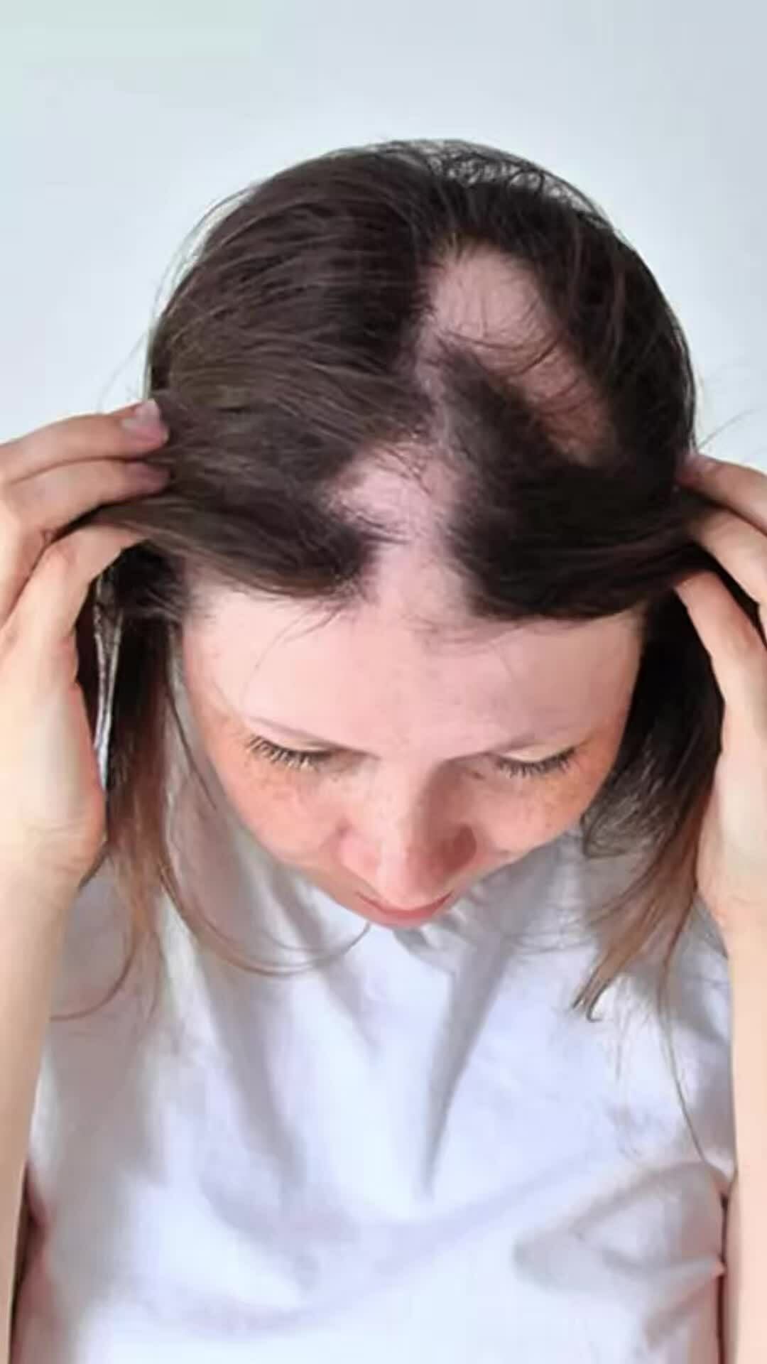 Phụ nữ sau 30 tuổi dễ rụng tóc do thiếu sắt và protein