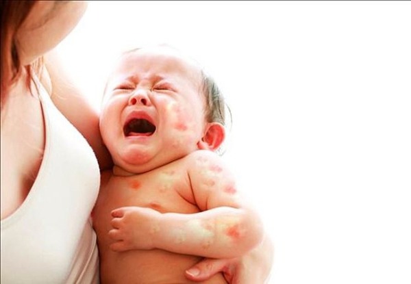 2-nguyen-nhan-be-bi-di-ung-dam-sua-bo Nguyên nhân bé bị dị ứng đạm sữa bò