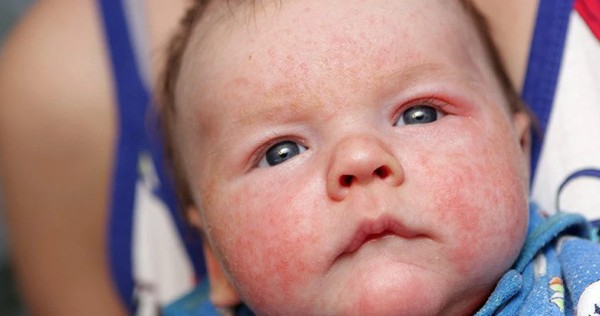 cham-sua-o-tre-so-sinh-1 Dấu hiệu phổ biến ở bé bị chàm sữa