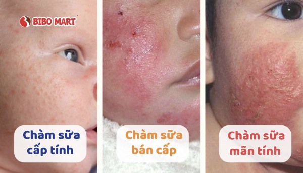 cham-sua-o-tre-so-sinh-2 Các cấp độ chàm sữa sơ sinh