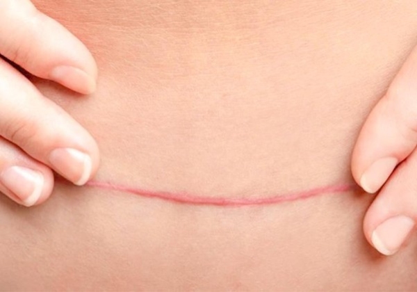 Mẹ bị sẹo thâm đỏ sau sinh