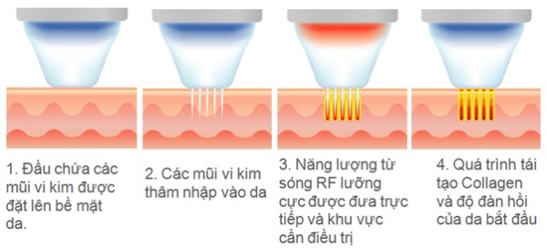 Quy trình thẩm mỹ vết sẹo mổ đẻ bằng công nghệ RF vi điểm 