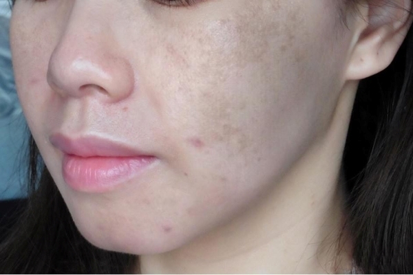 Tia UV trong ánh sáng mặt trời có thể gây ảnh hưởng xấu đến làn da mẹ bầu