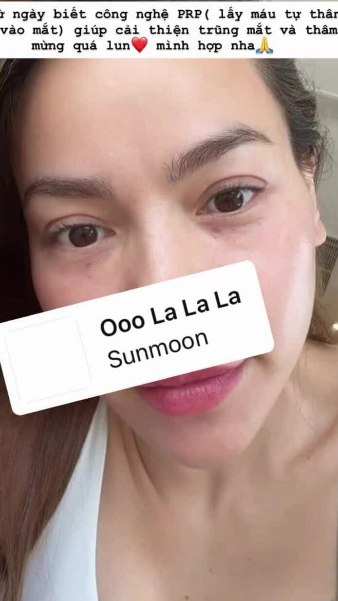 Liệu pháp giúp Hồ Ngọc Hà 'xóa' quầng thâm mắt